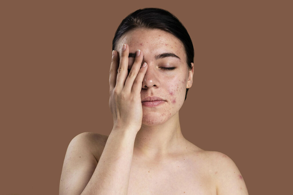 sinais de disturbios hormonais